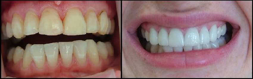 Before and After Veneers