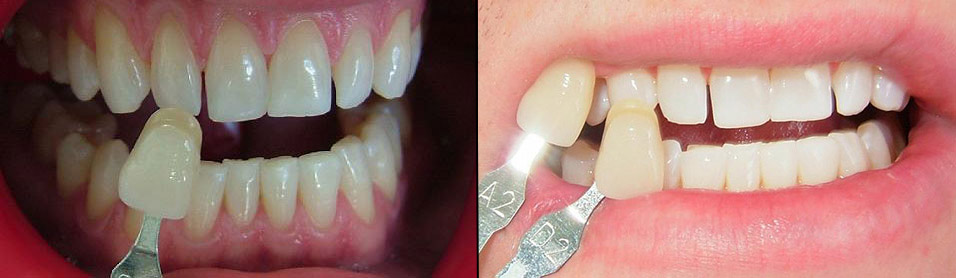 invisalign