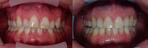 Before and After