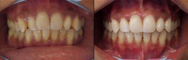 Before and After