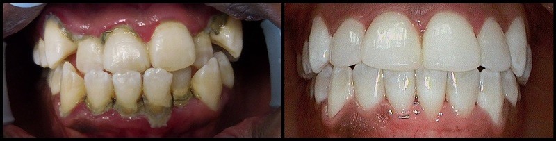 766 Before and After